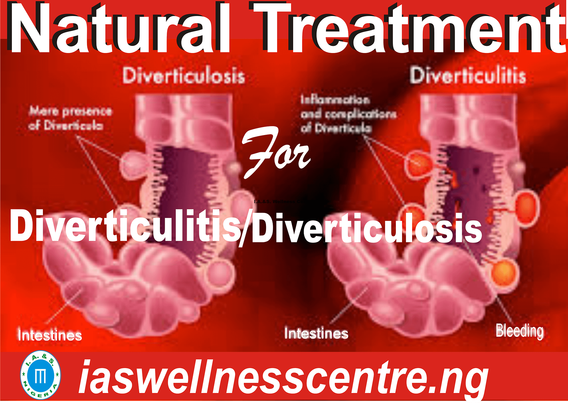 Diverticulitis Symptoms Treatment And More EEJIOQ diverticulitis-symptoms-treatment-and-more-eejioq