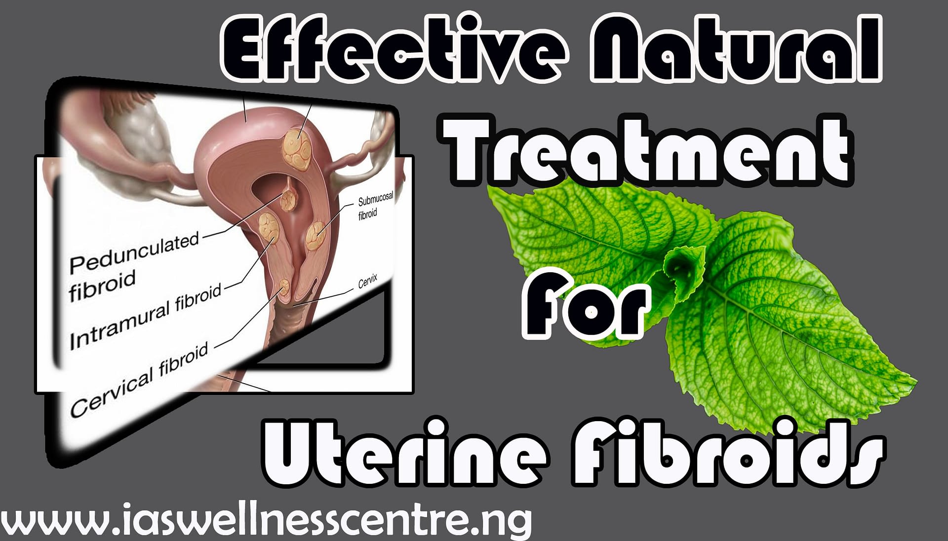 effective natural treatment for uterine fibroids I.A.S Wellness Centre