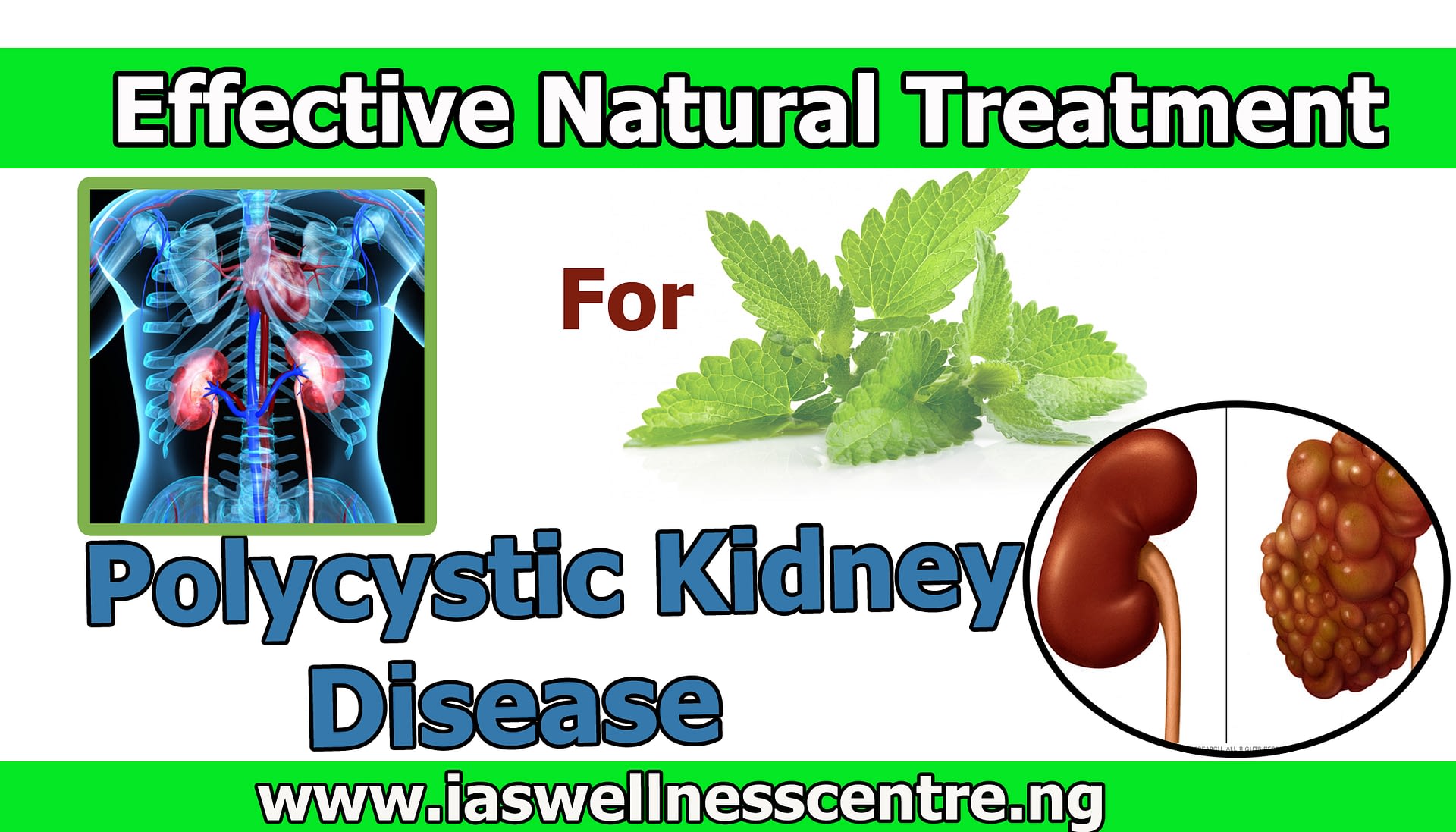 effective-natural-treatment-for-polycystic-kidney-disease-pkd-in